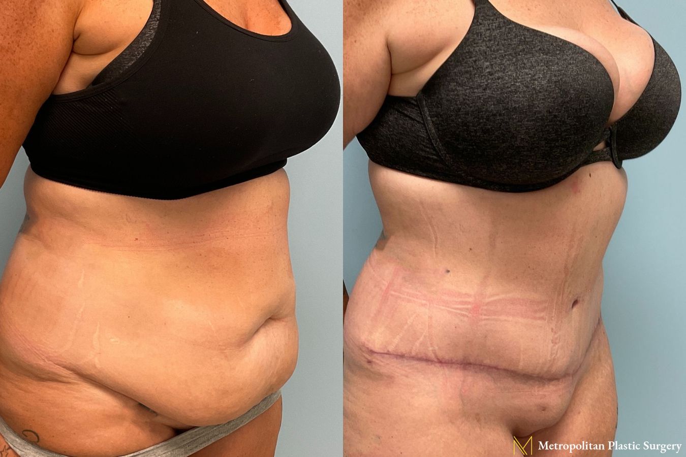 Before and after Tummy Tuck case 8006 - Angle 5