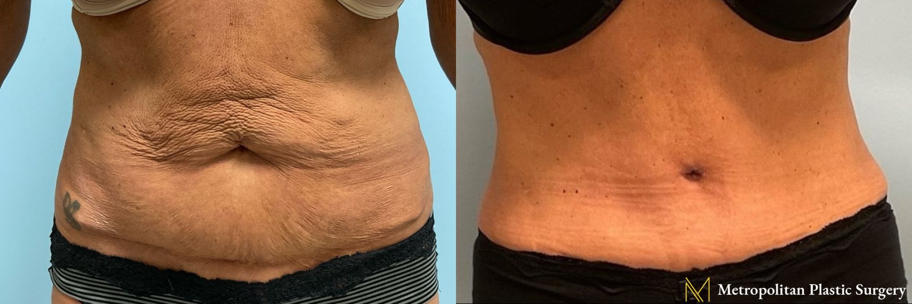 Before & after abdominoplasty photos for abdominoplasty