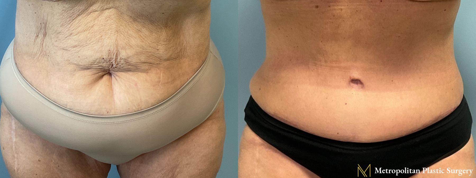 Before and after Tummy Tuck case 41756