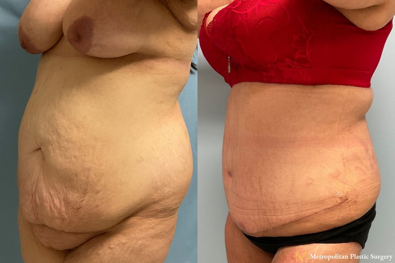 Before and after Tummy Tuck case 8051 - Angle 3