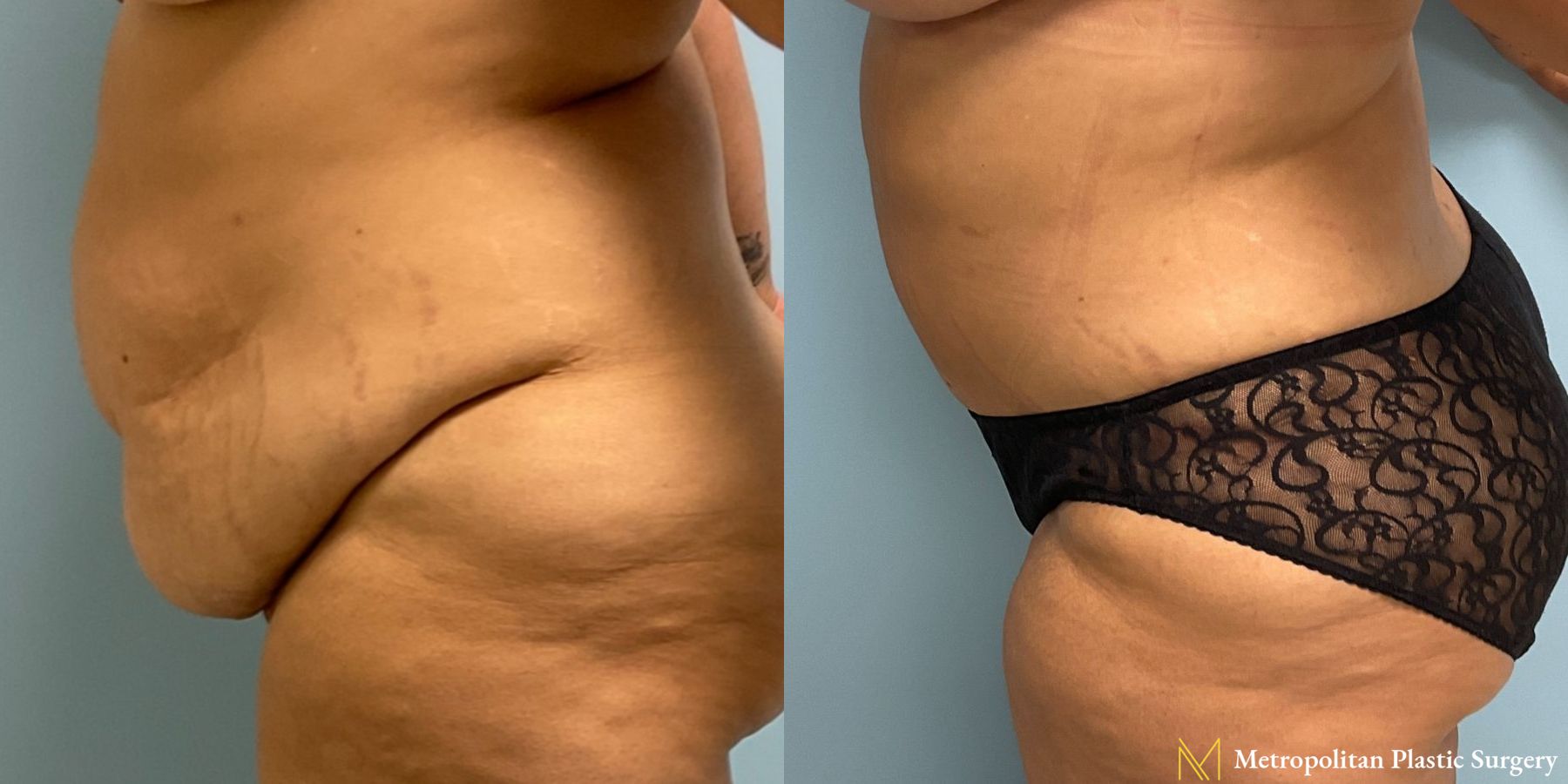 Before and after Tummy Tuck case 8052 - Angle 5