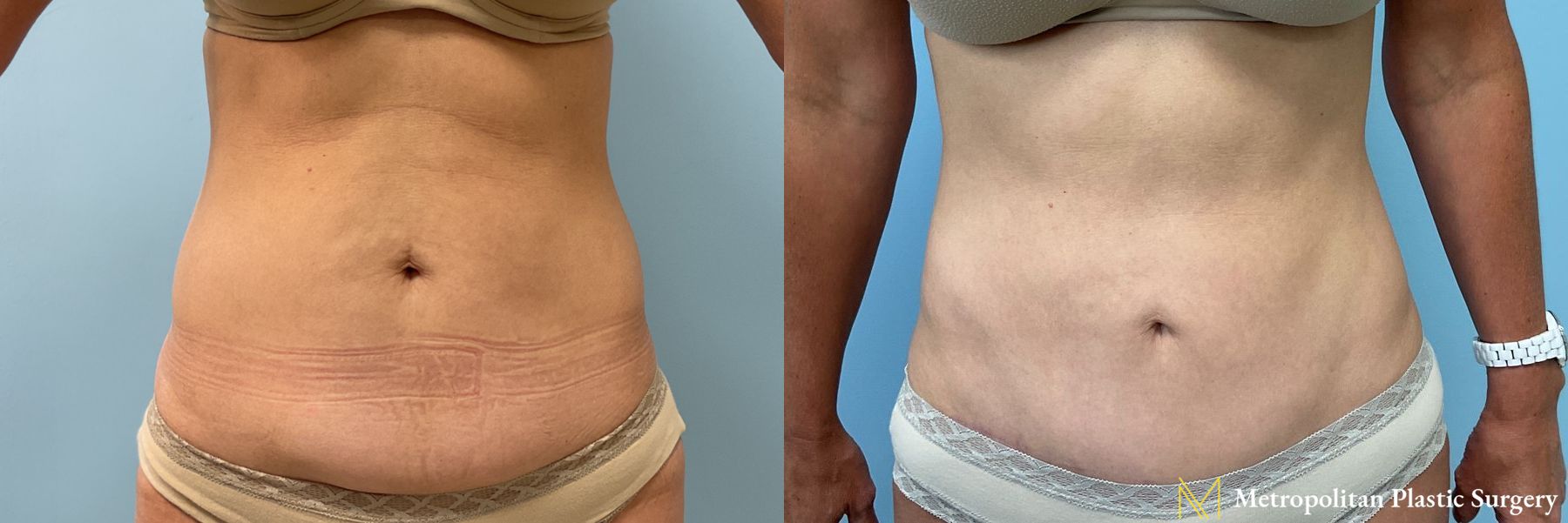 Before and after Tummy Tuck case 23849