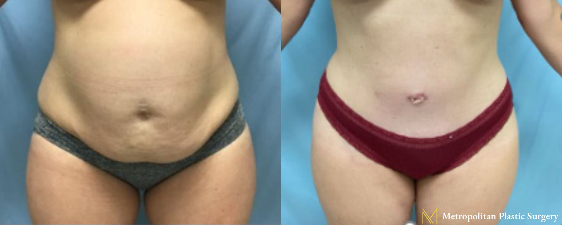 Before and after Tummy Tuck case 41785