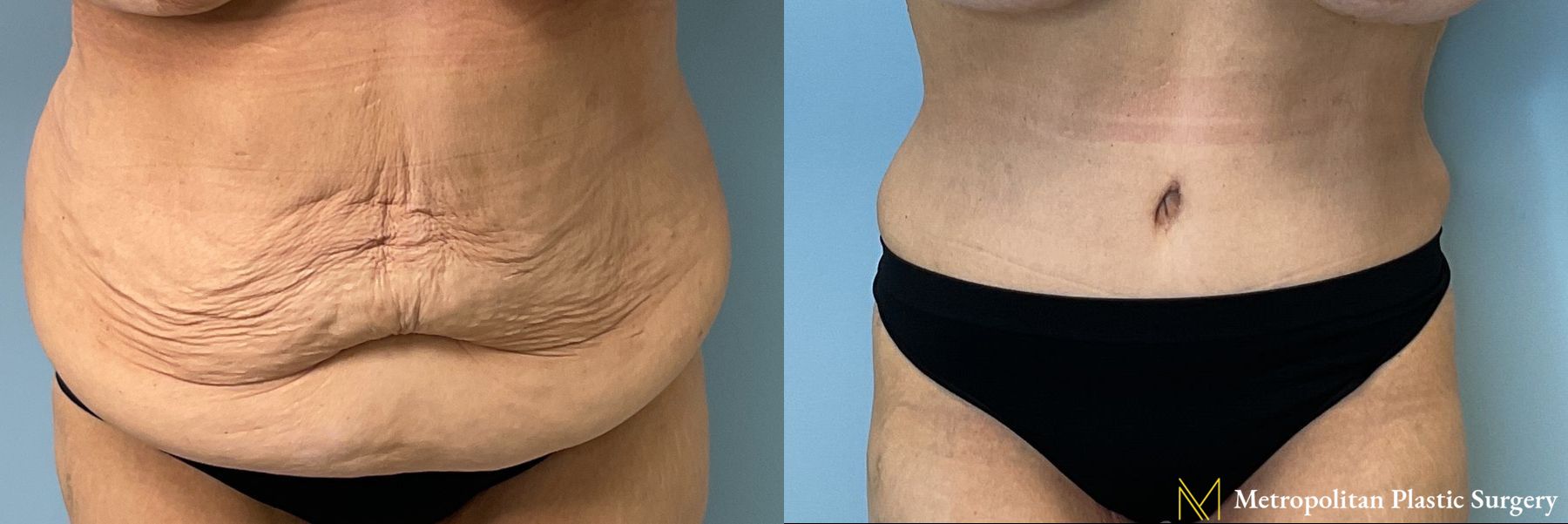Before and after Tummy Tuck case 41784