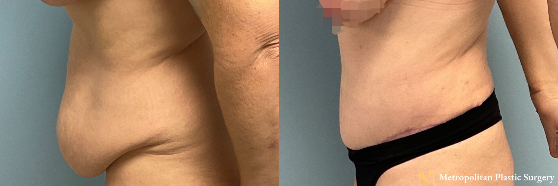 Tummy Tuck performed by Dr. Julia Spears - Angle 3