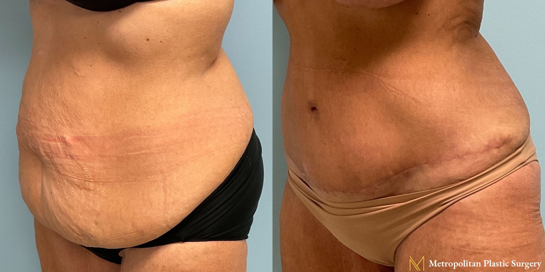 Before & after abdominoplasty photos for abdominoplasty - Angle 4