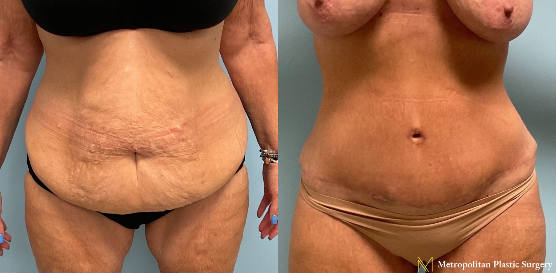 Before and after Tummy Tuck case 8039