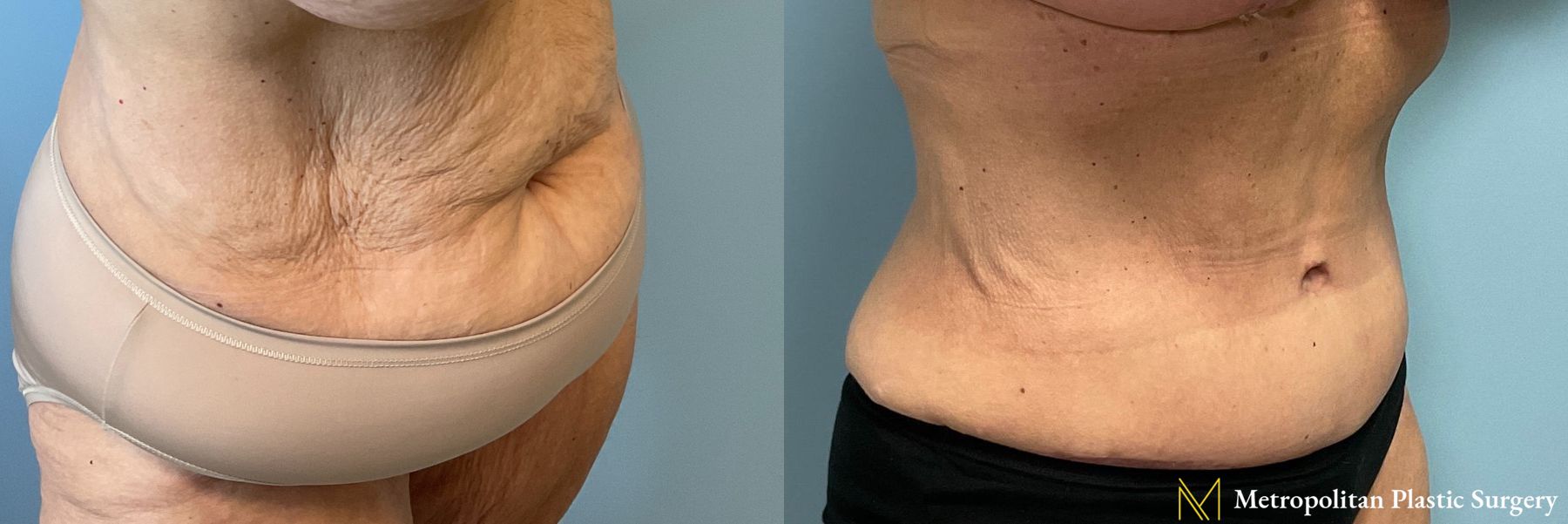 Before and after Tummy Tuck case 41756 - Angle 2