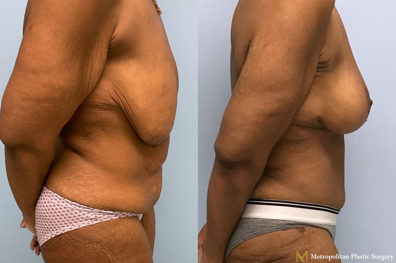 Before and after Tummy Tuck case 7999 - Angle 2