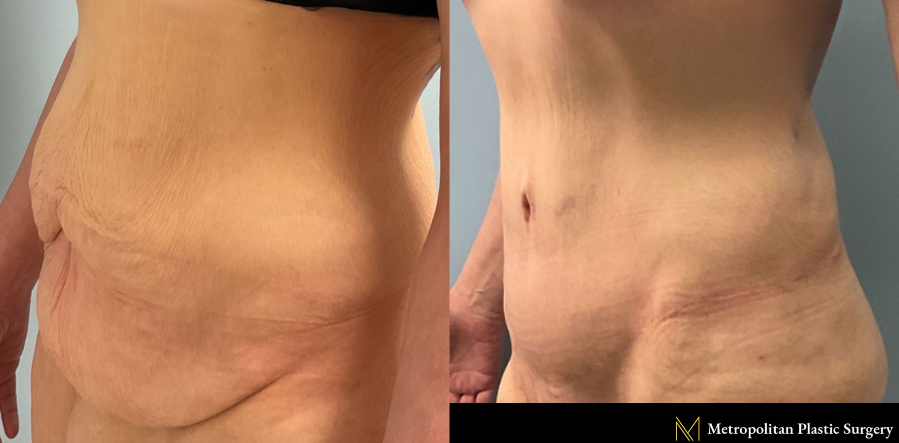 Tummy Tuck performed by Dr. Julia Spears at Metropolitan Plastic Surgery - Angle 2