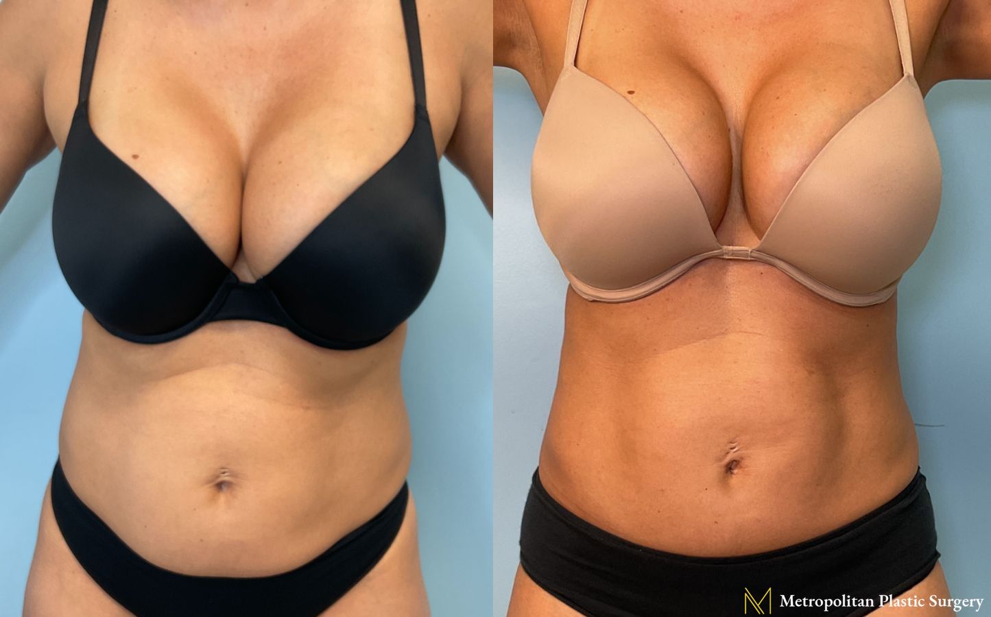 Mini Tummy Tuck performed by Dr. Julia Spears