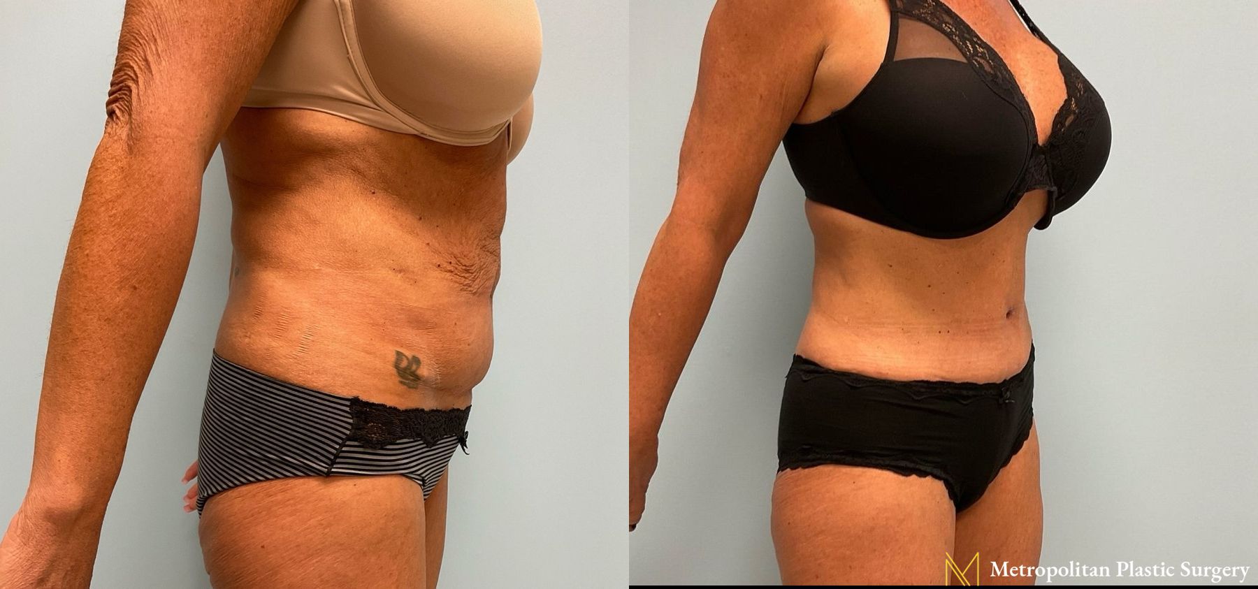 Before and after Tummy Tuck case 8085 - Angle 2