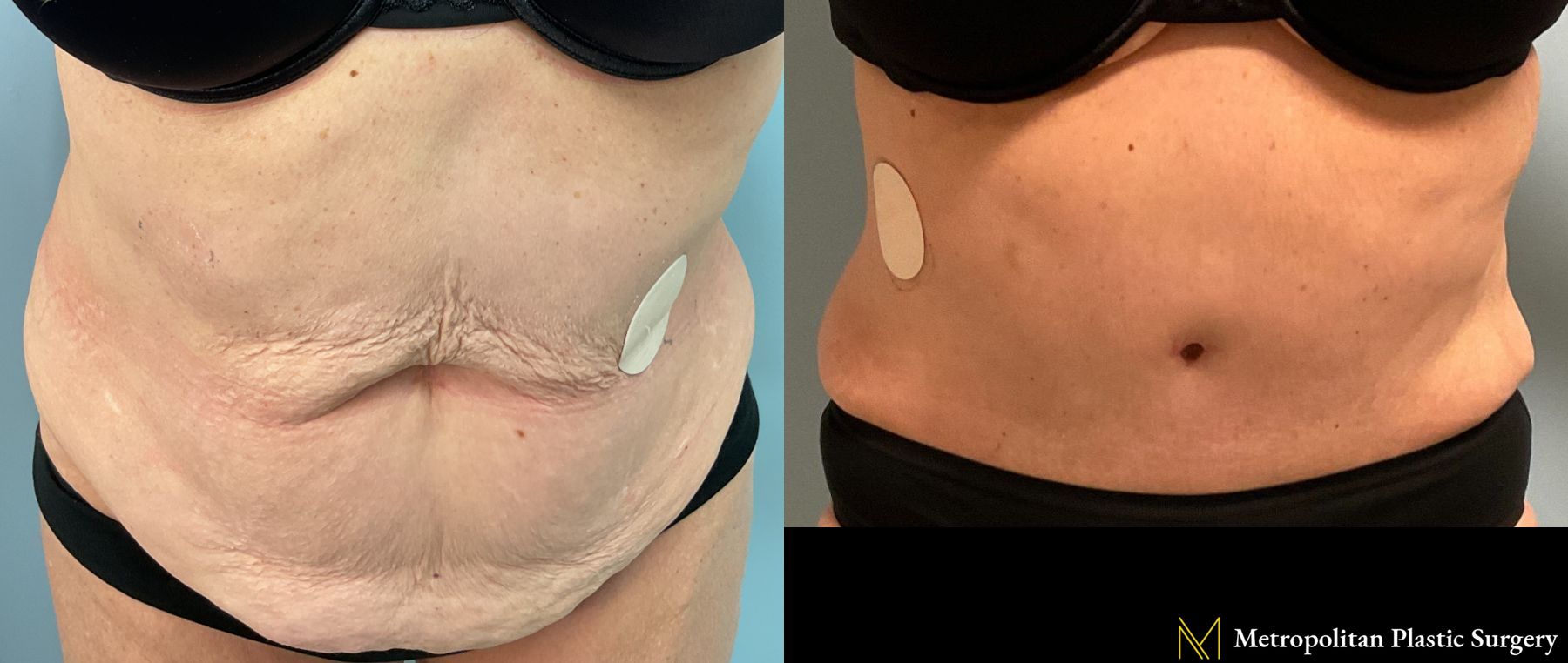 Tummy Tuck performed by Dr. Julia Spears - Angle 2