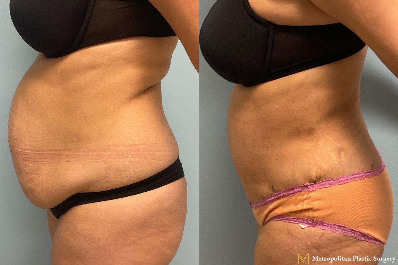Before and after Tummy Tuck case 8041 - Angle 4