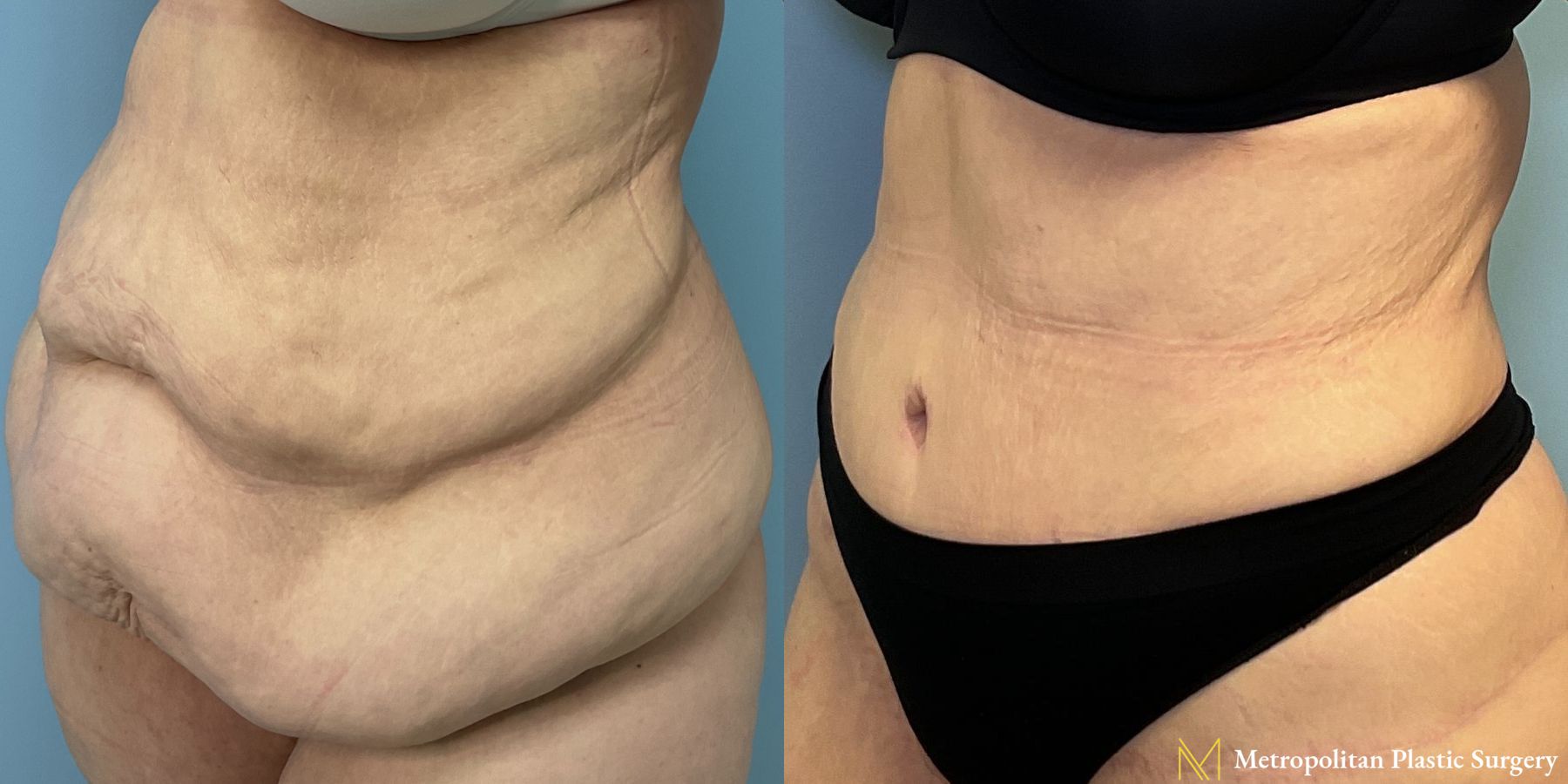 Tummy Tuck performed by Dr. Julia Spears - Angle 2