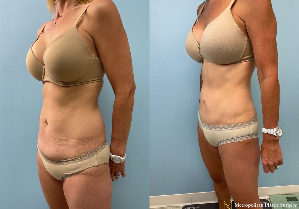 Liposuction - Thumbnail 2