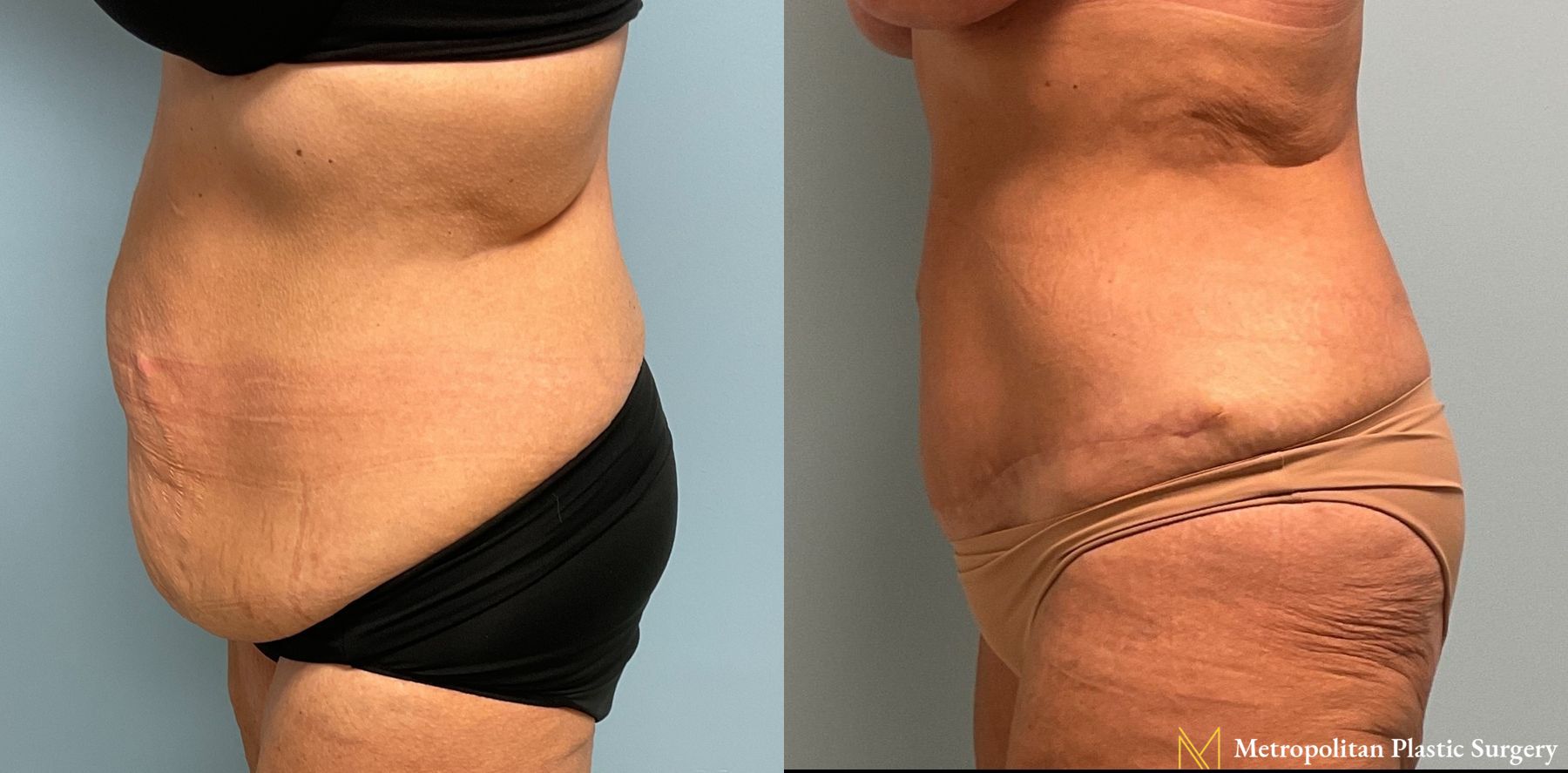 Before and after Tummy Tuck case 8039 - Angle 3