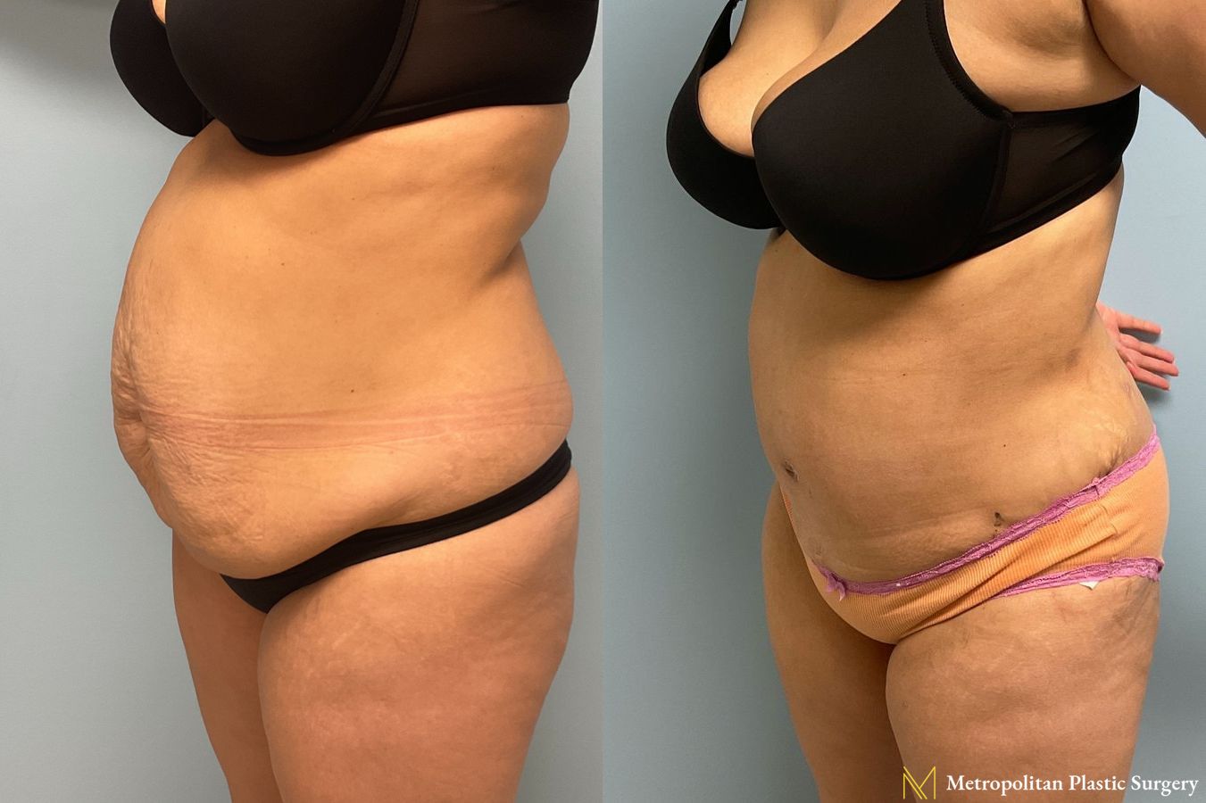Before and after Tummy Tuck case 8041 - Angle 3