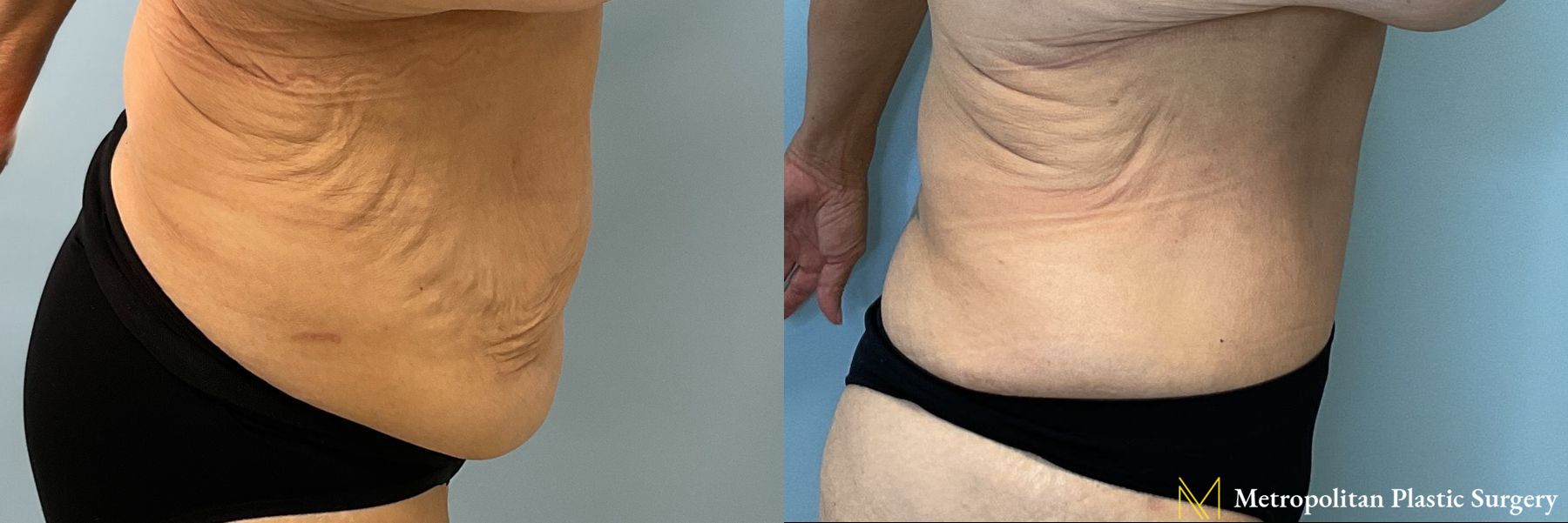 Before and after Tummy Tuck case 41784 - Angle 2