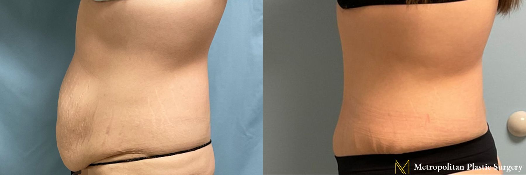 Tummy Tuck performed by Dr. Julia Spears - Angle 2