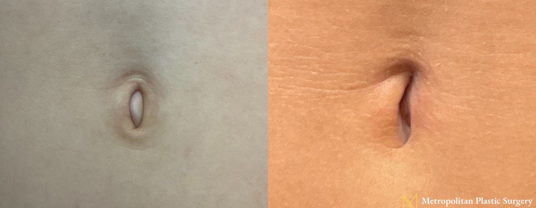 Umbilicoplasty - Case 92