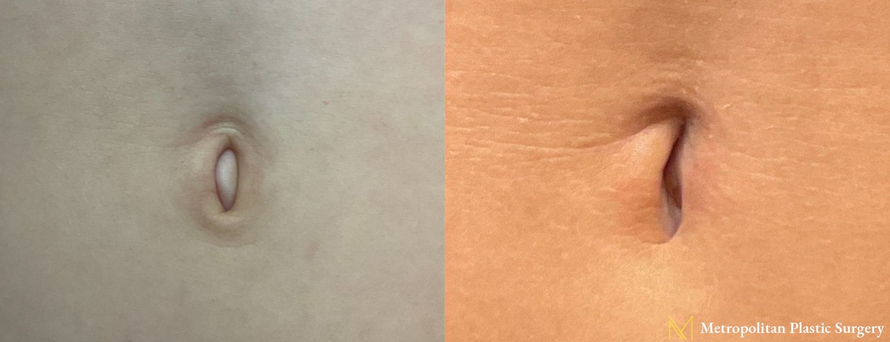 Before and after Umbilicoplasty case 17400