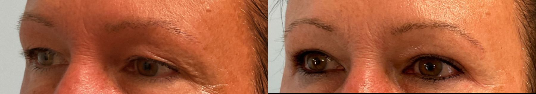 Upper Blepharoplasty performed by Dr. Julia Spears at the office of Metropolitan Plastic Surgery in Marlton, NJ