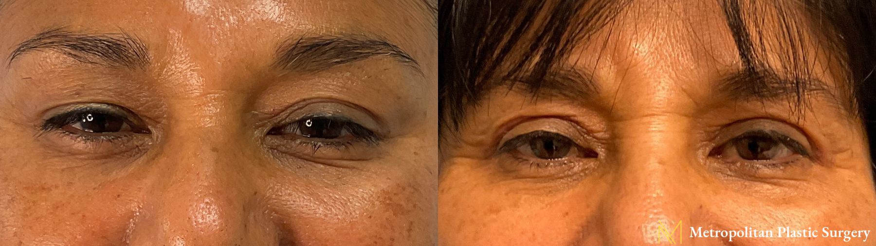 Before and after Upper Blepharoplasty case 41742