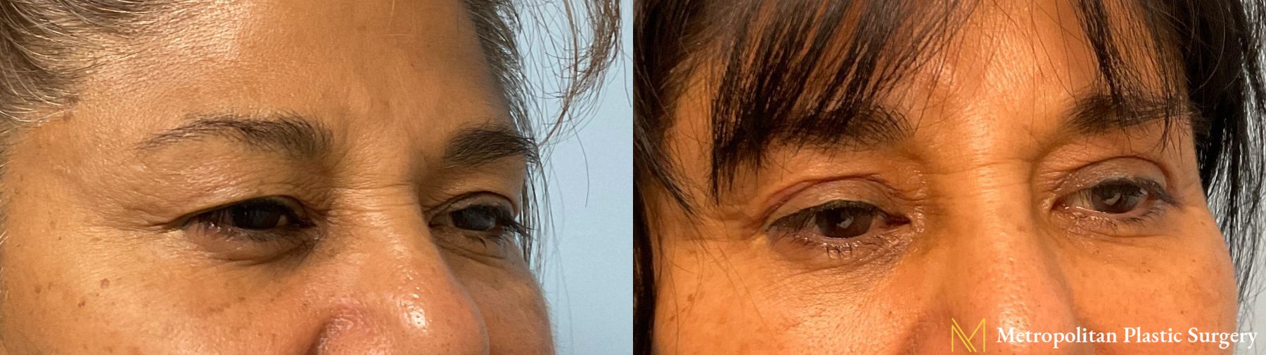 Before and after Upper Blepharoplasty case 41742 - Angle 2