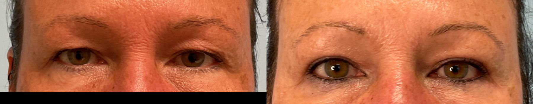 Upper Blepharoplasty performed by Dr. Julia Spears at the office of Metropolitan Plastic Surgery in Marlton, NJ - Angle 2