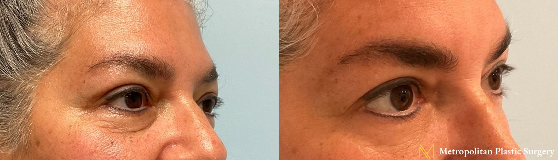 Julia Spears MD Eye Lid Surgery (Blepharoplasty) Before and After - Angle 2