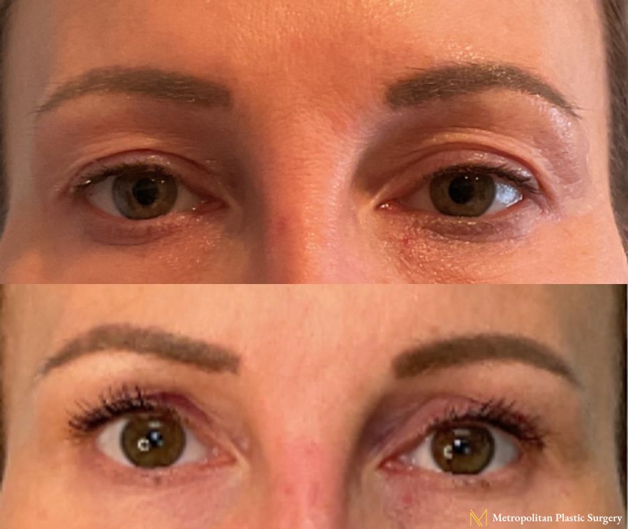 Upper Blepharoplasty performed by Dr. Julia Spears - Angle 2