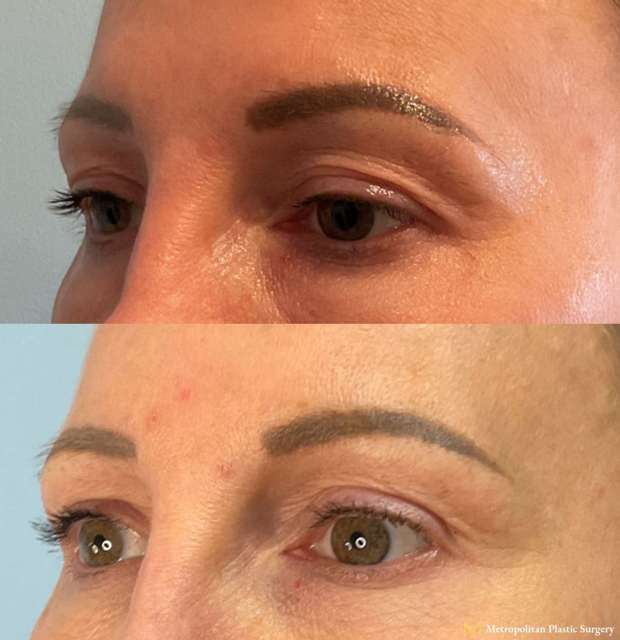 Upper Blepharoplasty performed by Dr. Julia Spears