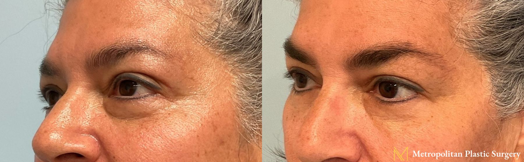 Julia Spears MD Eye Lid Surgery (Blepharoplasty) Before and After - Angle 3