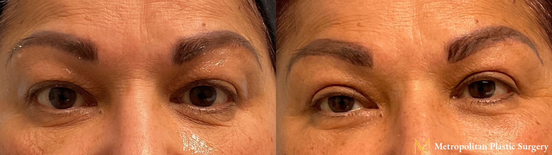 Upper Blepharoplasty performed by Dr. Julia Spears - Angle 2