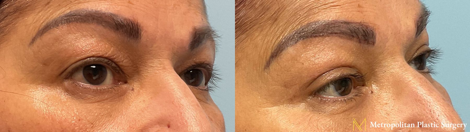Upper Blepharoplasty performed by Dr. Julia Spears
