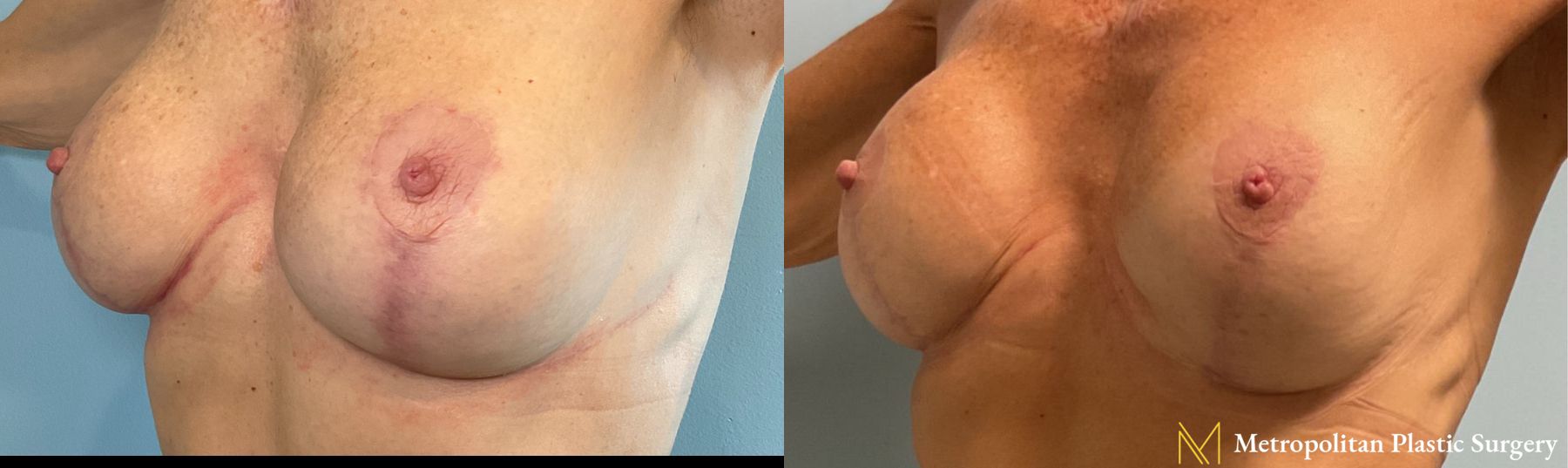 VI Peel for Breast Scars performed at the office of Dr. Julia Spears, MD, FACS at Metropolitan Plastic Surgery - Angle 2