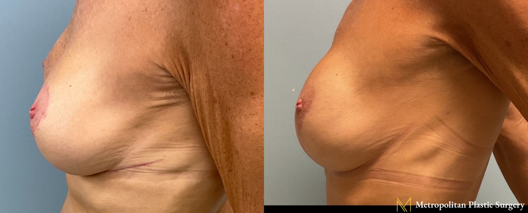 VI Peel for Breast Scars performed at the office of Dr. Julia Spears, MD, FACS at Metropolitan Plastic Surgery - Angle 3