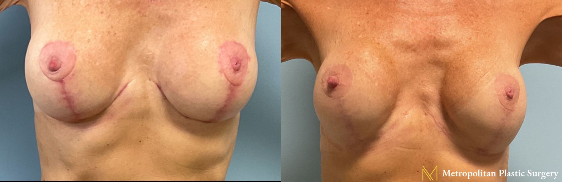 VI Peel for Breast Scars performed at the office of Dr. Julia Spears, MD, FACS at Metropolitan Plastic Surgery