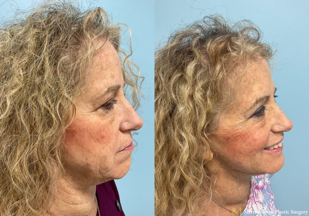 Facelift & Neck Lift - Thumbnail 3