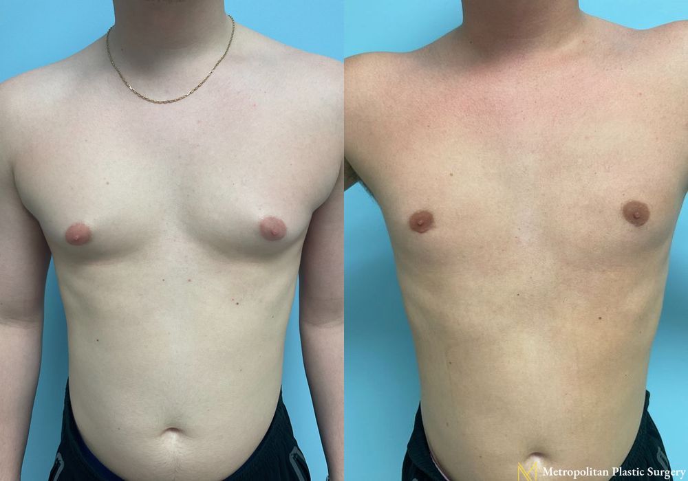 Gynecomastia - Case 113