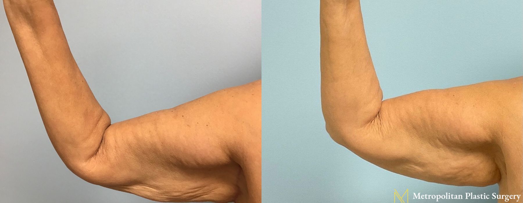 Brachioplasty - Thumbnail 4