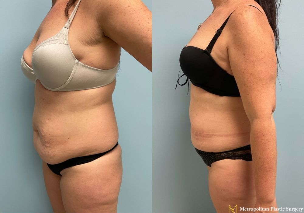 Liposuction - Thumbnail 2