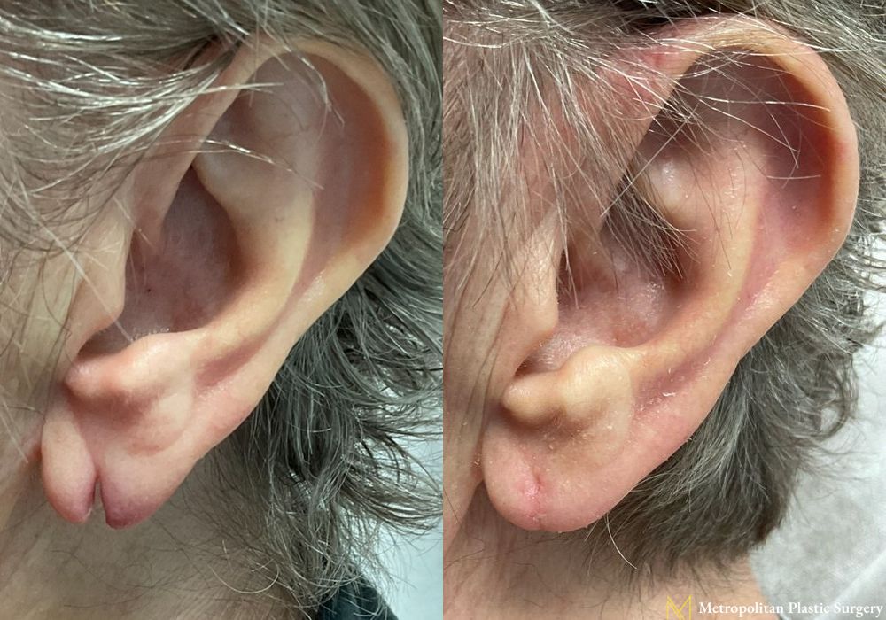 Earlobe Surgery - Case 124