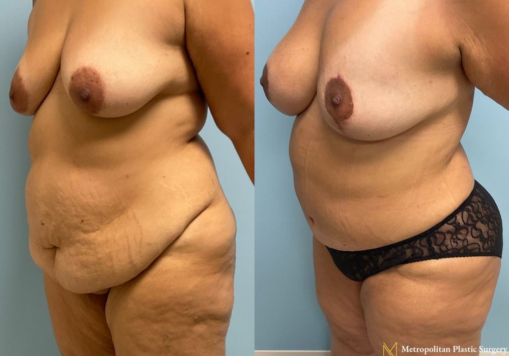 Abdominoplasty - Thumbnail 4