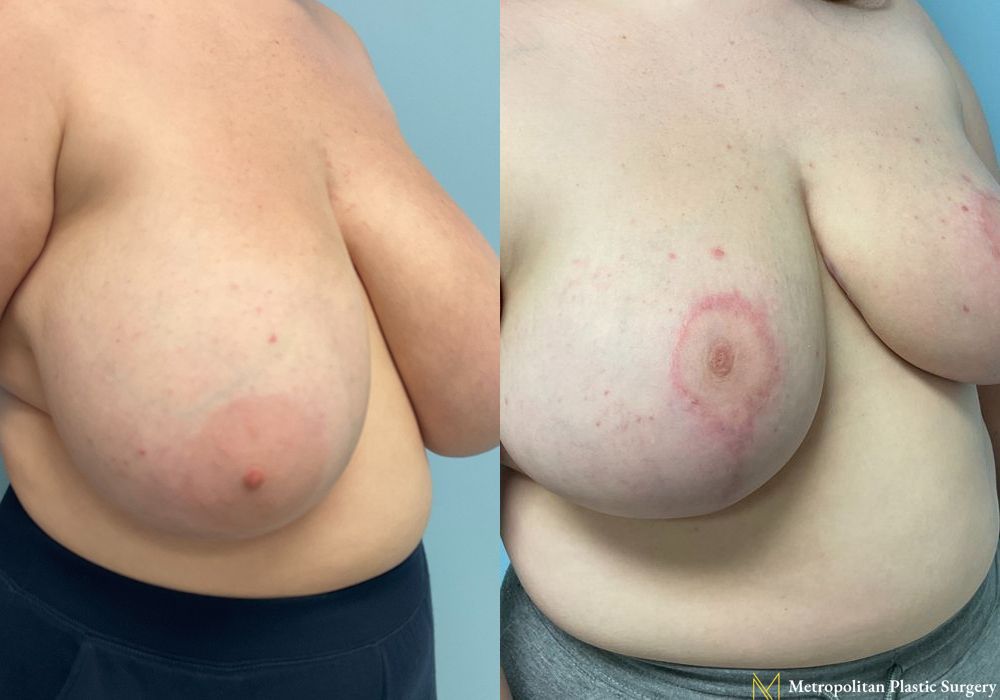 Breast Reduction - Thumbnail 4