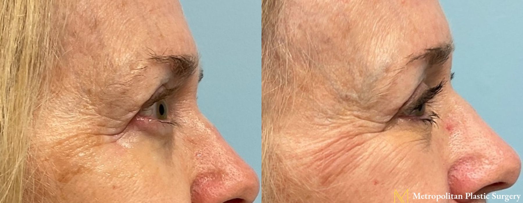 Blepharoplasty - Case 116