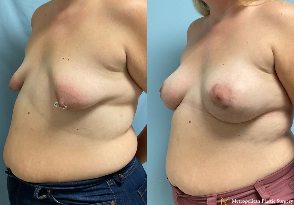 Breast Augmentation - Thumbnail 3
