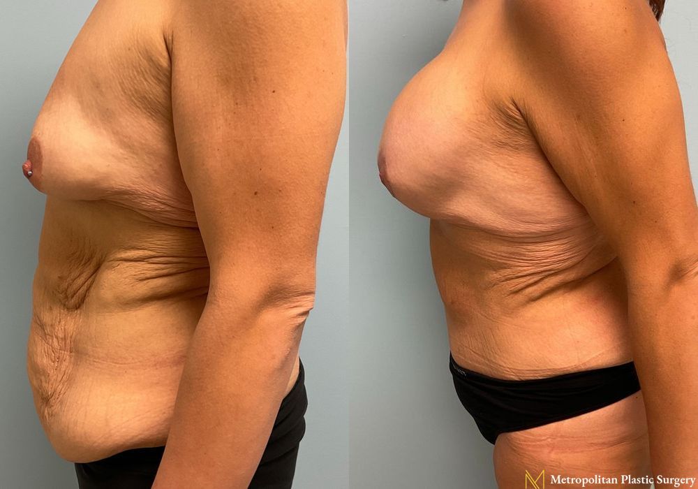 Abdominoplasty - Thumbnail 4