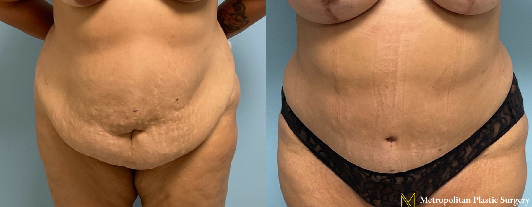 Abdominoplasty - Thumbnail 2